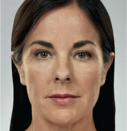 Elevation Med Spa - Dermal Fillers Before and After woman who had beauty injection in facial area